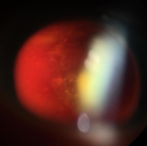 Inflammatory exudate in the vitreous body after ocular toxoplasmosis 